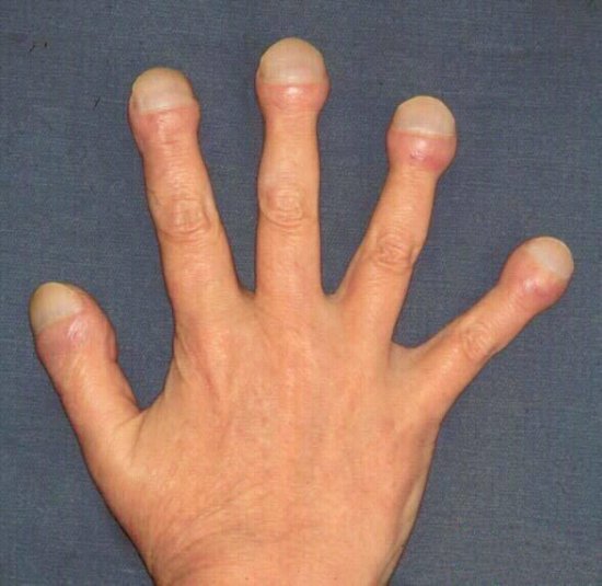 肺癌<em>对</em>人体到底都有哪些<em>危害</em>，为什么手指粗皮肤痒都能和肺癌...