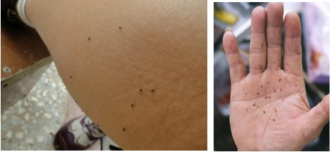 除了蚊子，这种小飞虫也会咬你一<em>腿</em>蚊子包！