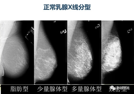 乳腺常见良性肿瘤及肿瘤样病变影像诊断