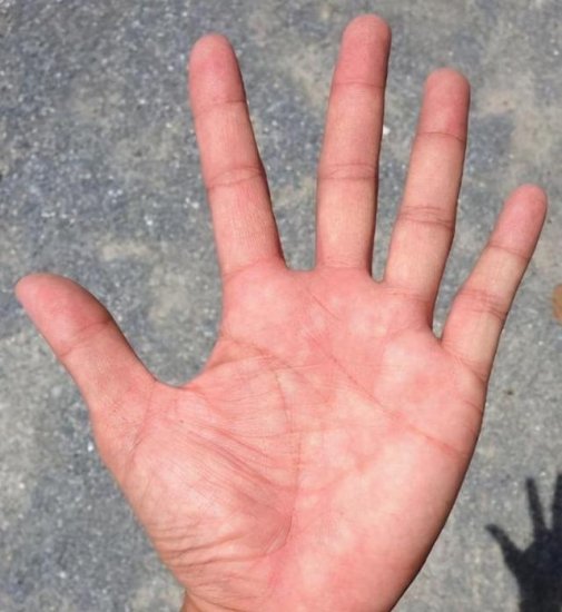 “三角<em>纹</em>在手，富到九十九”，手纹能看出身体存在的疾病吗？