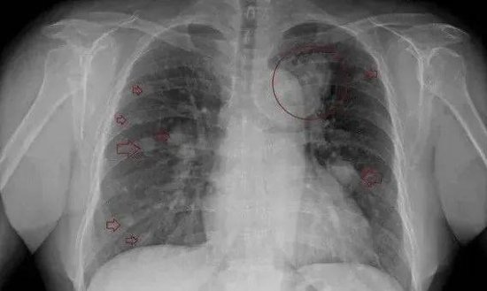 X光胸片能发现早癌吗？什么方法查肺癌<em>最准确</em>？