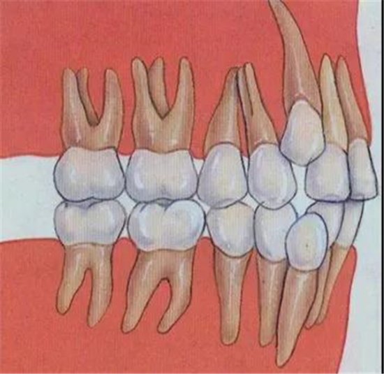 矫牙容易造成<em>牙齿脱落</em>？这些正畸谣言你信了几个？
