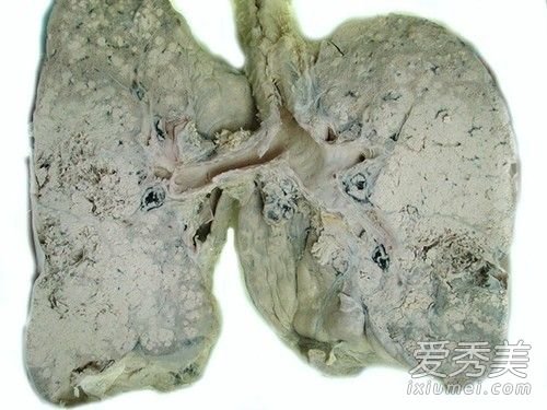 北京 肺癌/核心提示：肺癌的早期症状1.【咳嗽】，肺癌是什么原因引起的，...