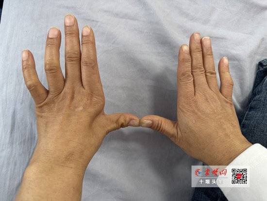 手指疼痛、弯曲无法伸直，太和专家手术修复女子“爪形手”