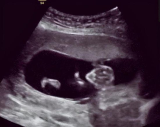 胎动在左边就是男生？“<em>男左女右</em>”的胎动判断，真的靠谱吗？