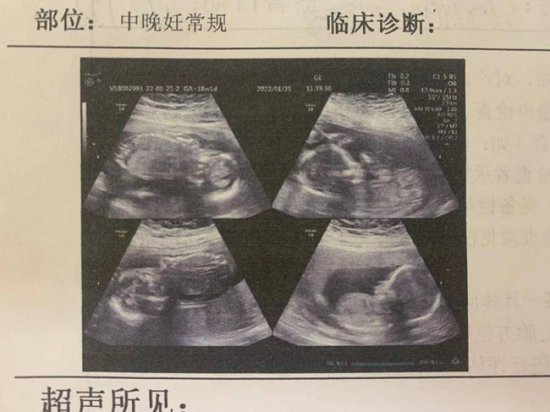 罕见！山东一孕妇怀四<em>胞胎</em>生产不同天： 两个早产，两个留腹中