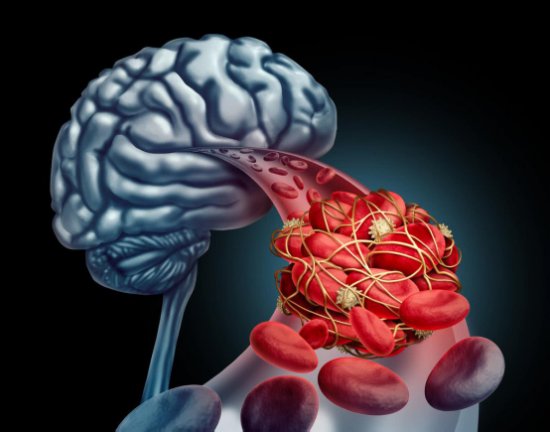 脑梗中风<em>前兆是什么</em>症状，胞倍力清血片降低心脑血管疾病风险