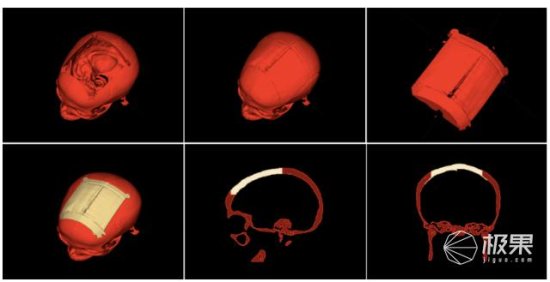 奥地利研究人员发布一款可3D打印颅骨植入物的自动化<em>设计软件</em>