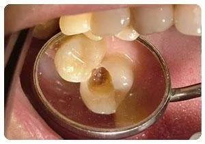补牙的<em>材料有</em>哪些？