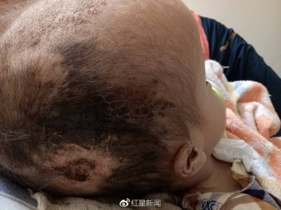 “外星人双胞胎”已筹得部分善款 将前往上海治疗