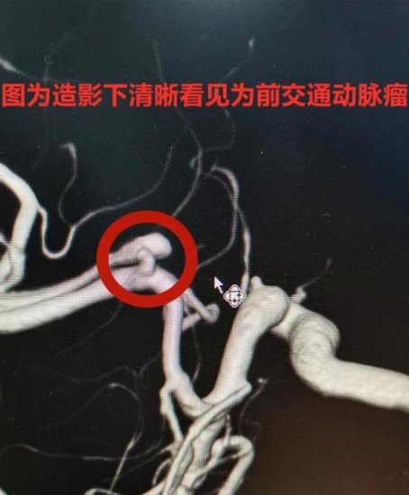 大三学生突发脑出血 黑龙江省医院助其重燃返校希望