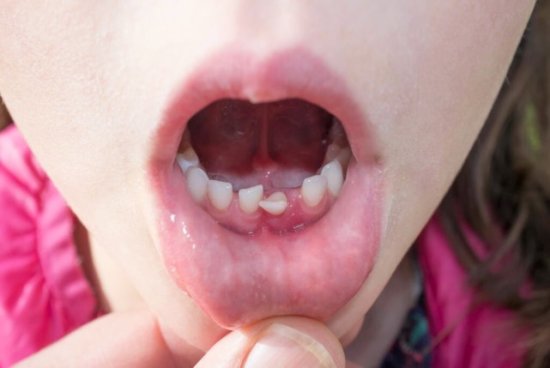 孩子长双排<em>牙</em>的原因，和父母的饮食疏忽有关，妈妈们后悔莫及