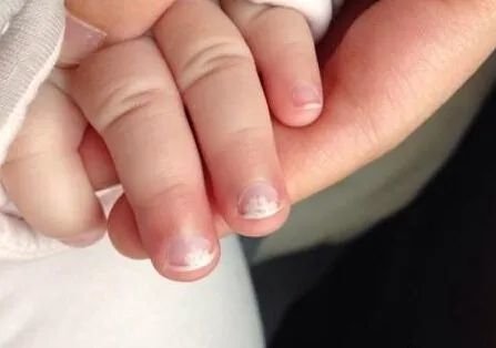 3岁女童<em>手指甲</em>莫名脱落，罪魁祸首原来是这种病，家长要当心！