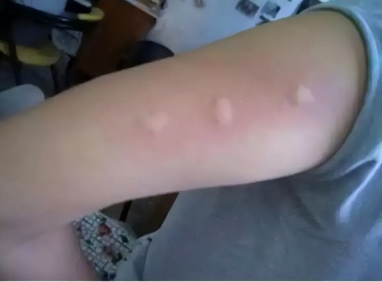 孩子被蚊子咬，又红又<em>痒还</em>留疤，要怎么处理？教你正确护理方法