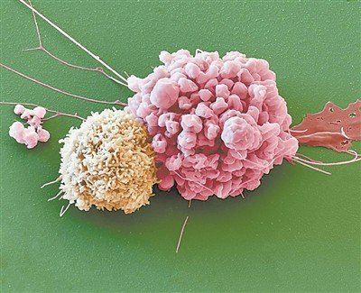 揭秘癌细胞与神经元的“共生共舞”