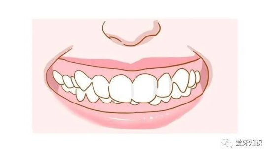 <em>成都</em>牙科医生任欢科普：深覆盖和深覆颌有什么区别和影响？