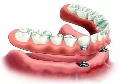 回龙观口腔：荷马口腔镶牙的三种方式<em>及优缺点</em>,您会选择哪一种?