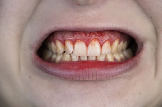 龋病、牙龈炎……这 4 种让你吃不香<em>的牙齿</em>问题怎么<em>治</em>？看完你就...