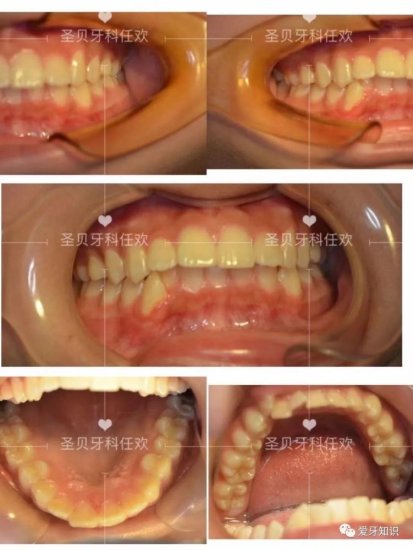 <em>成都</em>牙科医生任欢案例分享，深覆颌，深覆盖如何矫正，你的牙齿...