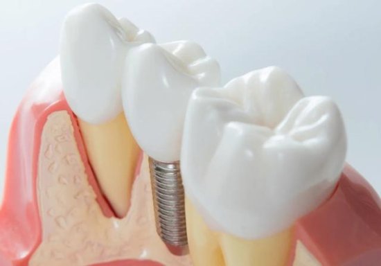 “人的第三副牙齿”<em>种植牙</em>究竟贵在哪？